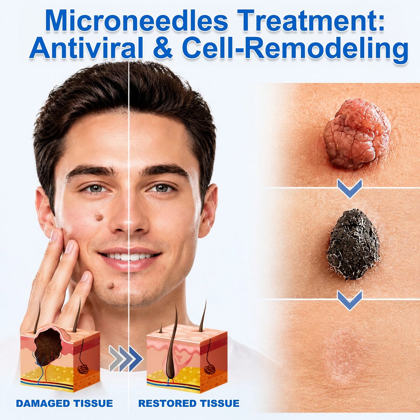 Pureshade® 2-in-1 Microneedle & Hydrocolloid Patch ✨Invisible Face & Body Patches for Raised Moles, Acne, Flat Warts & Skin Tags - Helps Improve the Appearance of Wrinkles, Scars & Blemishes