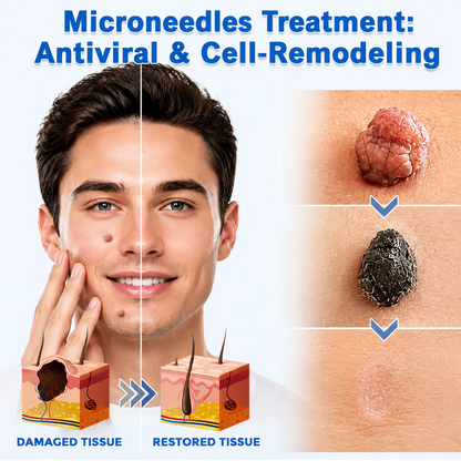 Hiskin ® 2-in-1 Microneedle & Hydrocolloid Patch🍀 | Removes raised moles, acne, flat warts, and skin tags | Helps improve wrinkles, scars, and blemishes | Invisible patches for face and body