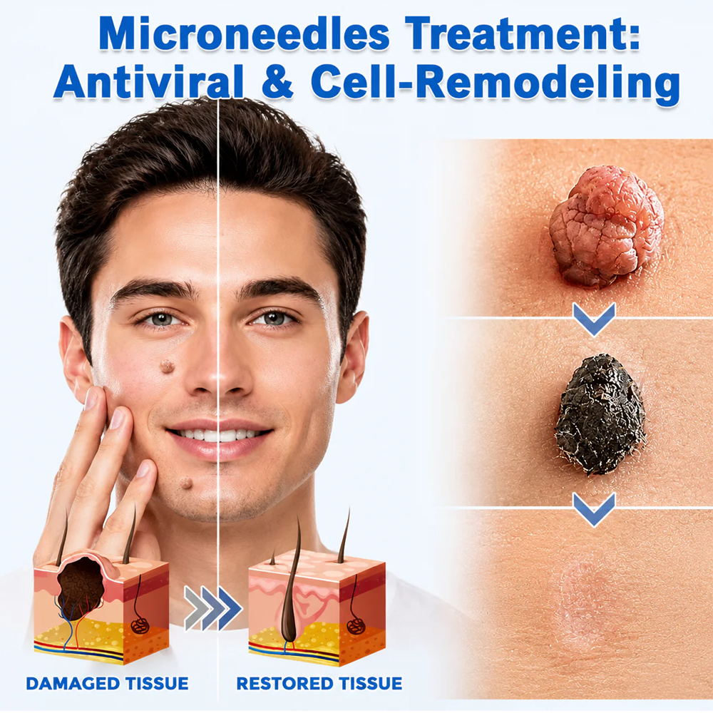 Hiskin ® 2-in-1 Microneedle & Hydrocolloid Patch🍀 | Removes raised moles, acne, flat warts, and skin tags | Helps improve wrinkles, scars, and blemishes | Invisible patches for face and body