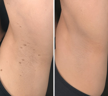 Hiskin ® 2-in-1 Microneedle & Hydrocolloid Patch✨ | Removes raised moles, acne, flat warts, and skin tags | Helps improve wrinkles, scars, and blemishes | Invisible patches for face and body