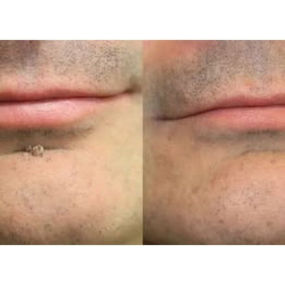 Hiskin ® 2-in-1 Microneedle & Hydrocolloid Patch✨ | Removes raised moles, acne, flat warts, and skin tags | Helps improve wrinkles, scars, and blemishes | Invisible patches for face and body
