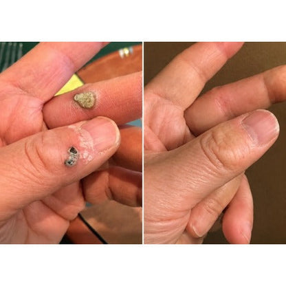 Hiskin ® 2-in-1 Microneedle & Hydrocolloid Patch🍀 | Removes raised moles, acne, flat warts, and skin tags | Helps improve wrinkles, scars, and blemishes | Invisible patches for face and body