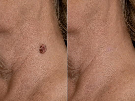 Hiskin ® 2-in-1 Microneedle & Hydrocolloid Patch🍀🍀 | Removes raised moles, acne, flat warts, and skin tags | Helps improve wrinkles, scars, and blemishes | Invisible patches for face and body
