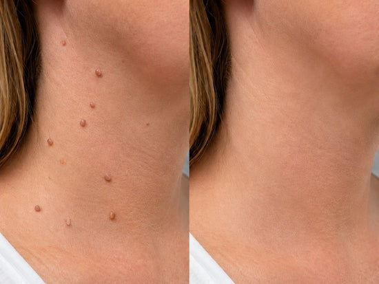 Hiskin ® 2-in-1 Microneedle & Hydrocolloid Patch🍀🍀 | Removes raised moles, acne, flat warts, and skin tags | Helps improve wrinkles, scars, and blemishes | Invisible patches for face and body