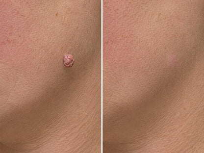 Hiskin ® 2-in-1 Microneedle & Hydrocolloid Patch🍀🍀 | Removes raised moles, acne, flat warts, and skin tags | Helps improve wrinkles, scars, and blemishes | Invisible patches for face and body