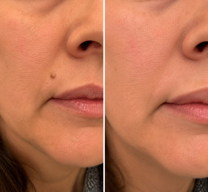 Pureshade® 2-in-1 Microneedle & Hydrocolloid Patch ✨Invisible Face & Body Patches for Raised Moles, Acne, Flat Warts & Skin Tags - Helps Improve the Appearance of Wrinkles, Scars & Blemishes